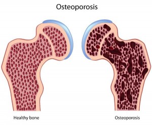 osteoporosis vegan foods vitamin k bone health